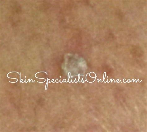 Ask A Dermatologist Scaly Skin Diseases Skin Specialists Online