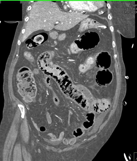 Pneumatosis With Ischemic Small Bowel Case Study Bowels