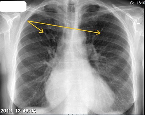 Pulmonary Edema Chest X Ray Wikidoc