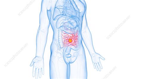 cancer of the small intestine illustration stock image f038 0342 science photo library