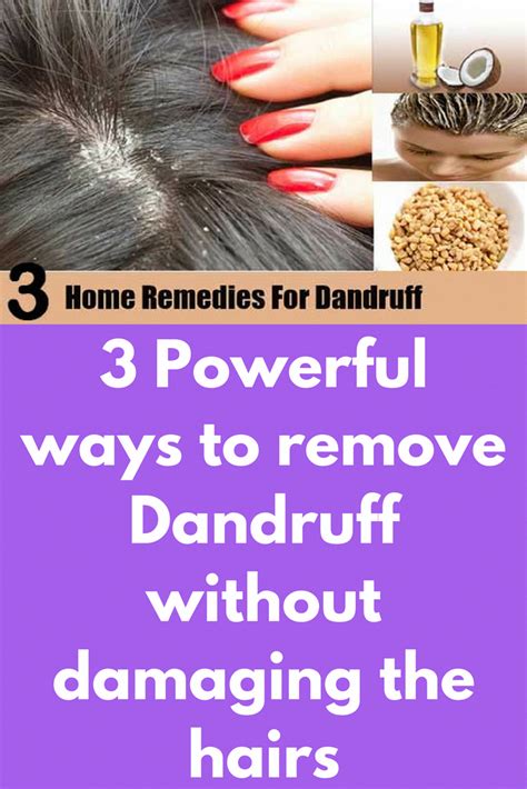 3 Powerful Ways To Remove Dandruff Without Damaging The Hairs 1 Curd