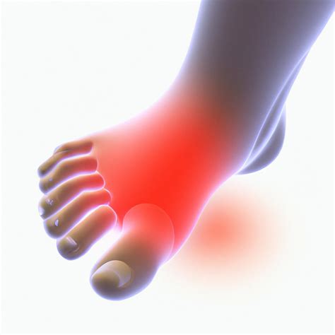 Understanding Cellulitis Of The Foot Symptoms And Recognition