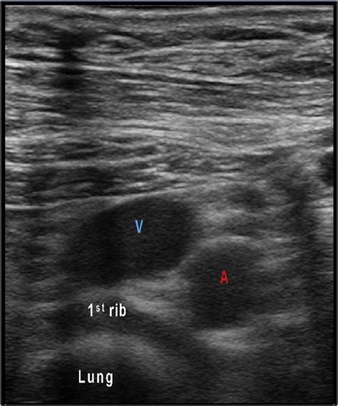 Axillary Mass Ultrasound