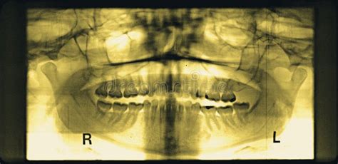 Full Mouth Dental Xray X Ray Stock Image Image 45618541