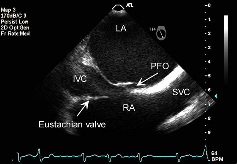 Morphology Of The Patent Foramen Ovale In Asymptomatic Versus