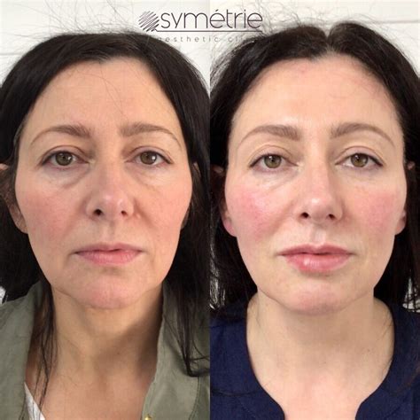 Full Face Rejuvenation With Dermal Fillers Symetrie