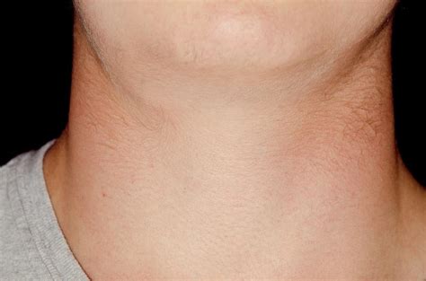 Swollen Lymph Gland In The Neck Photograph By Dr P Marazziscience