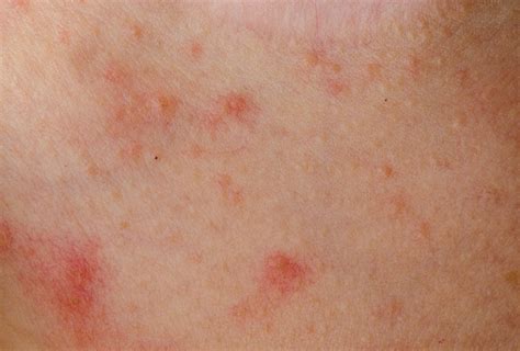 Top 10 Most Common Types Of Skin Rashes Gogohood