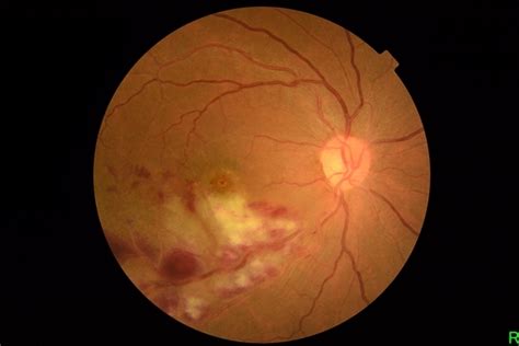 Retinal Ischemia Edema And Hemorrhages On The Infero Temporal Macula