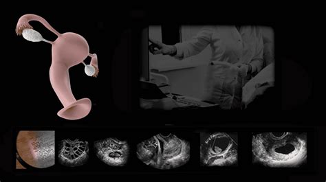 Transvaginal Pelvic Ultrasound Imaging Doppler Ultrasound Training