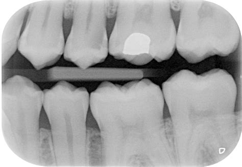 X Ray Example Of An Amalgam Filling And Tooth Decay The Center For