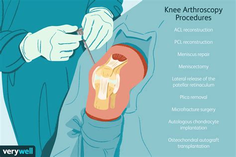 Knee Arthroscopy What To Expect On The Day Of Surgery