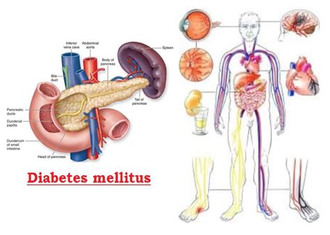 Diabetes Mellitus Sign And Symptoms Causes Diagnosis Complication