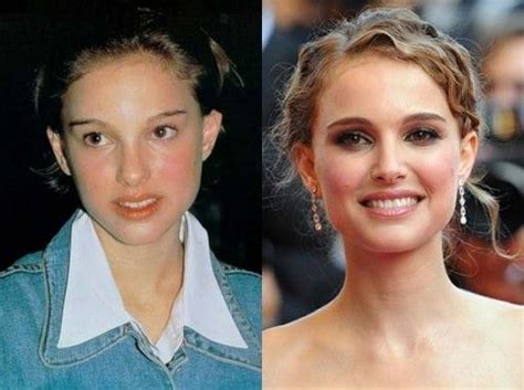 Natalie Portman Plastic Surgery Before And After Inspiring Your Life