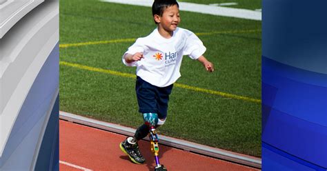 Child Amputee Celebrates Success With Mobility Clinic Cbs Colorado