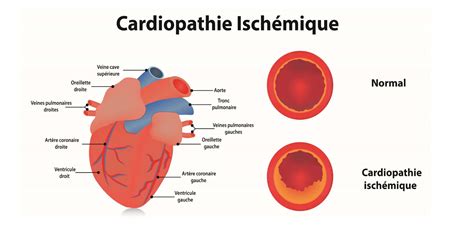 La Cardiopathie Ischémique Causes Et Traitements