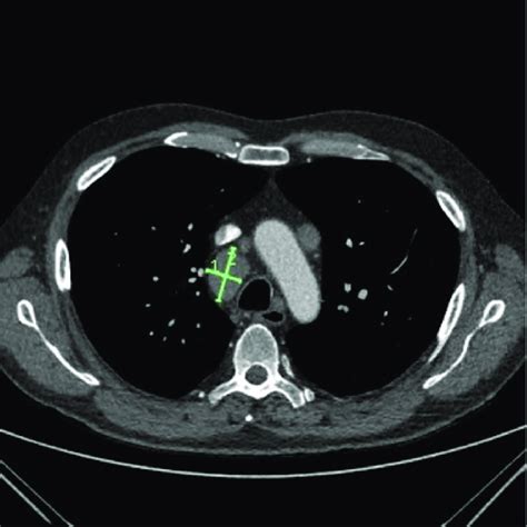 June 2018 Ct Chest Showing The Largest Lymph Node Right Paratracheal