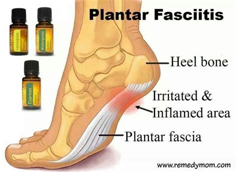 Pin On Plantar Fasciitis Cure And Treatment