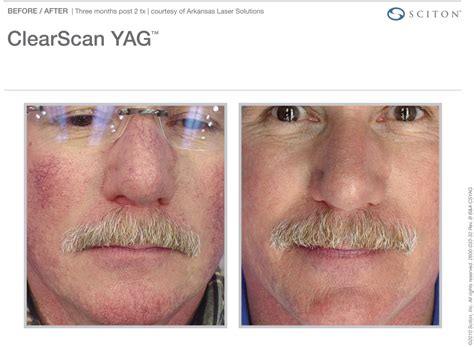 Before And After Treatments Photo Gallery Skin And Vein Md