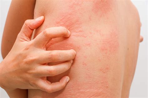Skin Allergies Rashes Do You Know What To Do Aesthetic