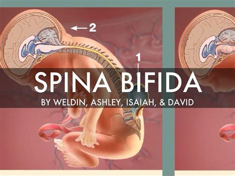 Spina Bifida By Giovvanna Palermo