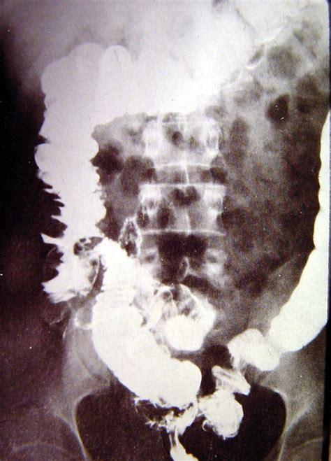 Colon Diverticular Disease 1823 Cecum Diverticulitis Surgery Photos