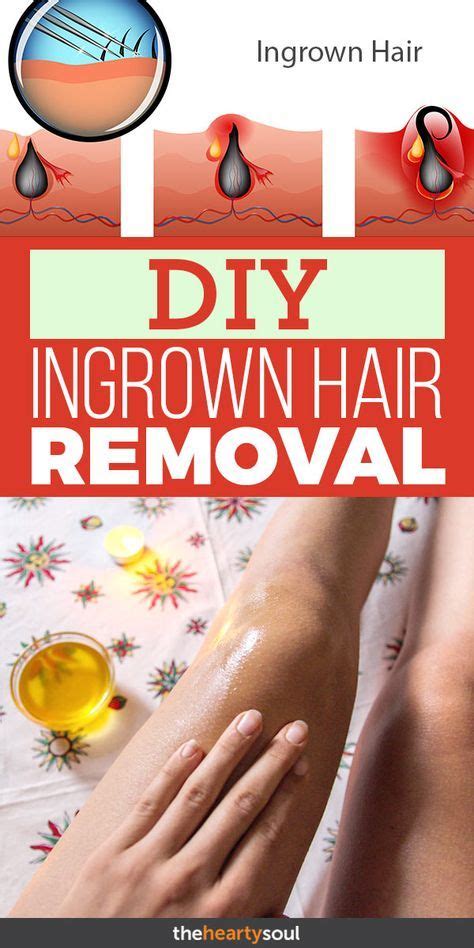 Ingrown Hair Removal Natural Remedy For Ingrown Hair With Essential