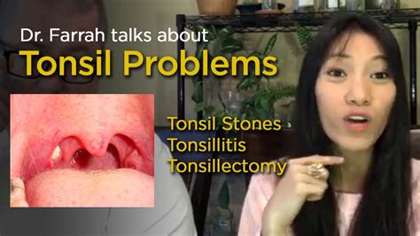 Dr Farrah On Tonsillitis And Tonsil Stones Is Tonsillectomy Surgery
