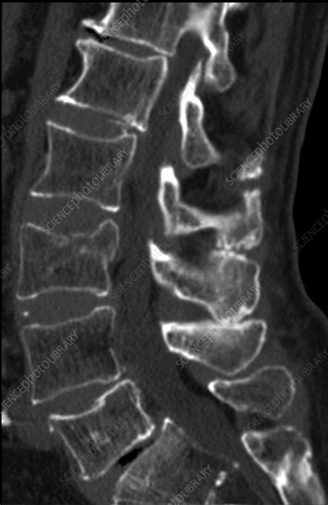 Acute Compression Fracture Of L3 Ct Scan Stock Image C0393635