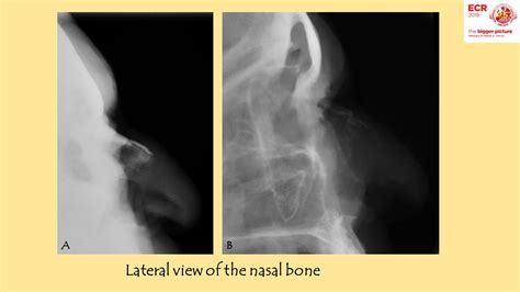 Nasal Bone X Ray Views Sexiz Pix