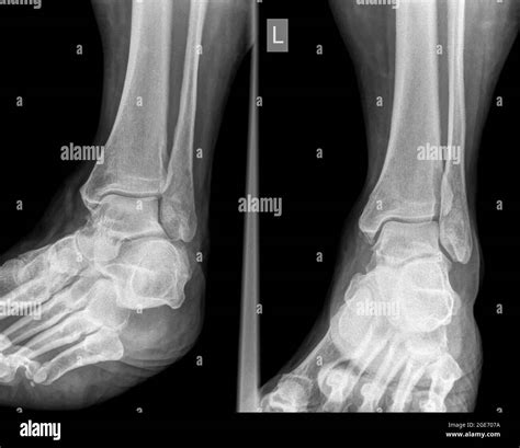 Distal Tibia Black And White Stock Photos And Images Alamy