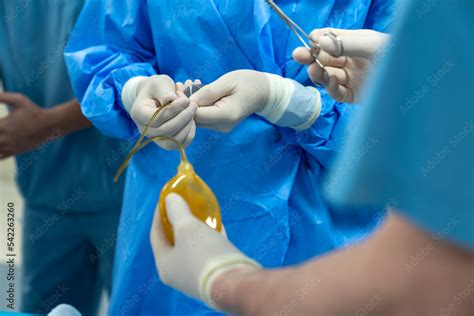 Penis Penile Implant Penis Enlargement Surgery Balloon Insertion