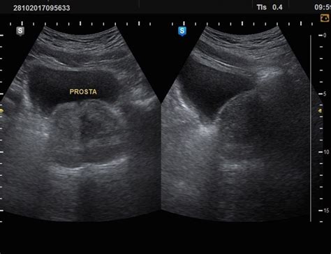 Check Up Prostatico Ultrasonido D Y D Hd Live Doppler Y Biopsias