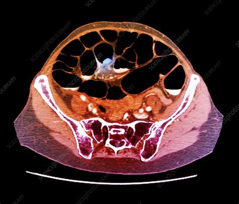 Colon Cancer Ct Scan Stock Image C0479254 Science Photo Library