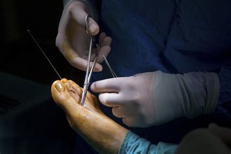 Plantar Fasciitis Surgery Recovery Time Healthy Living