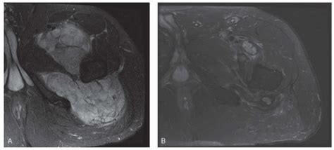 Soft Tissue Tumors Evaluation And Diagnosis Musculoskeletal Key