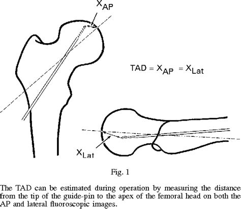 Figure 1 From Awareness Of Tip Apex Distance Reduces Failure Of