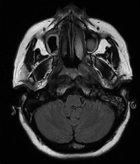 Mri Brain Axial View Showing Bilateral Maxillary Sinusitis And Left