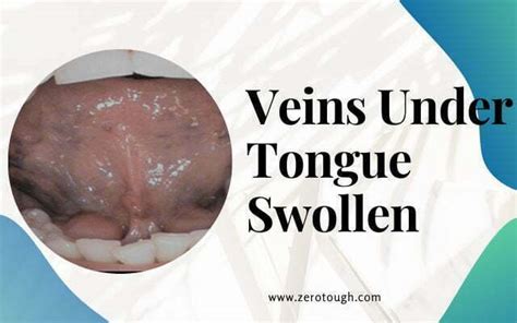 Veins Under Tongue Swollen Zero Tough