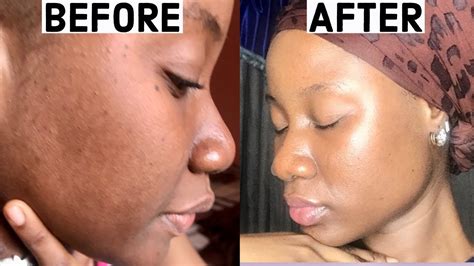 Hyperpigmentation Treatment For Black Skin How To Fade Dark Spots