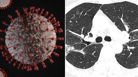 Penyebabnya beragam, seperti infeksi virus dan bakteri. Baru Saja Dirilis Ilmuwan, Begini Foto Paru-paru Penderita ...