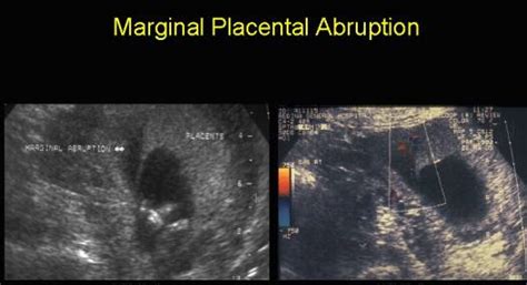 Ultrasound Of Placental Hematoma And Abruption