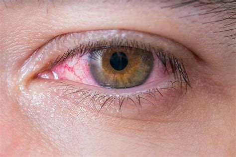 healthguide tips red eyes common symptoms causes and treatment
