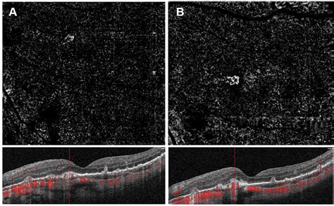 Frontiers Case Report Bilateral Choroidal Neovascular Membranes In A