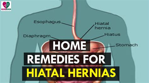 Home Remedies For Hiatal Hernias Health Sutra Youtube