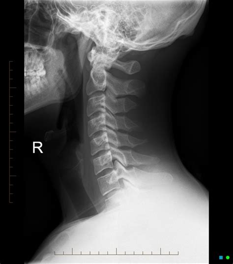 Normal Cervical Spine Radiographs Radiology Case