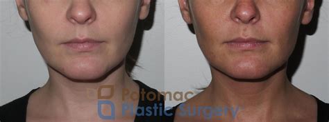 Kybella Before And After Photo Gallery Washington Dc Potomac Plastic