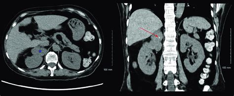 Computed Tomography Ct Abdomen With Adrenal Protocol Showing A