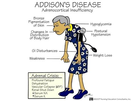 Addisons Disease Symptoms Cause Diagnosis And Treatment Reckon Talk