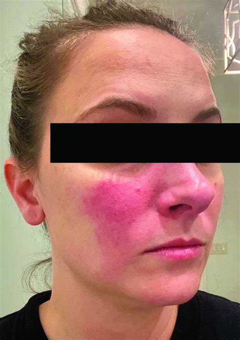 Rosacea And The Gut Looking Into Sibo Mdedge Dermatology